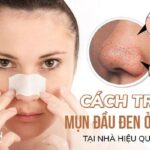 Top 9 cách trị mụn đầu đen ở mũi tại nhà hiệu quả