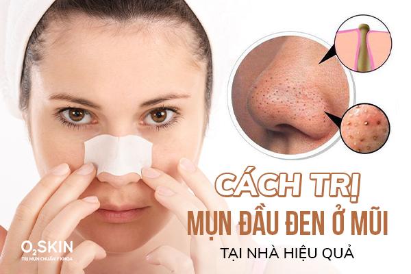 Cách Trị Mụn Đầu Đen Ở Mũi Tại Nhà Hiệu Quả