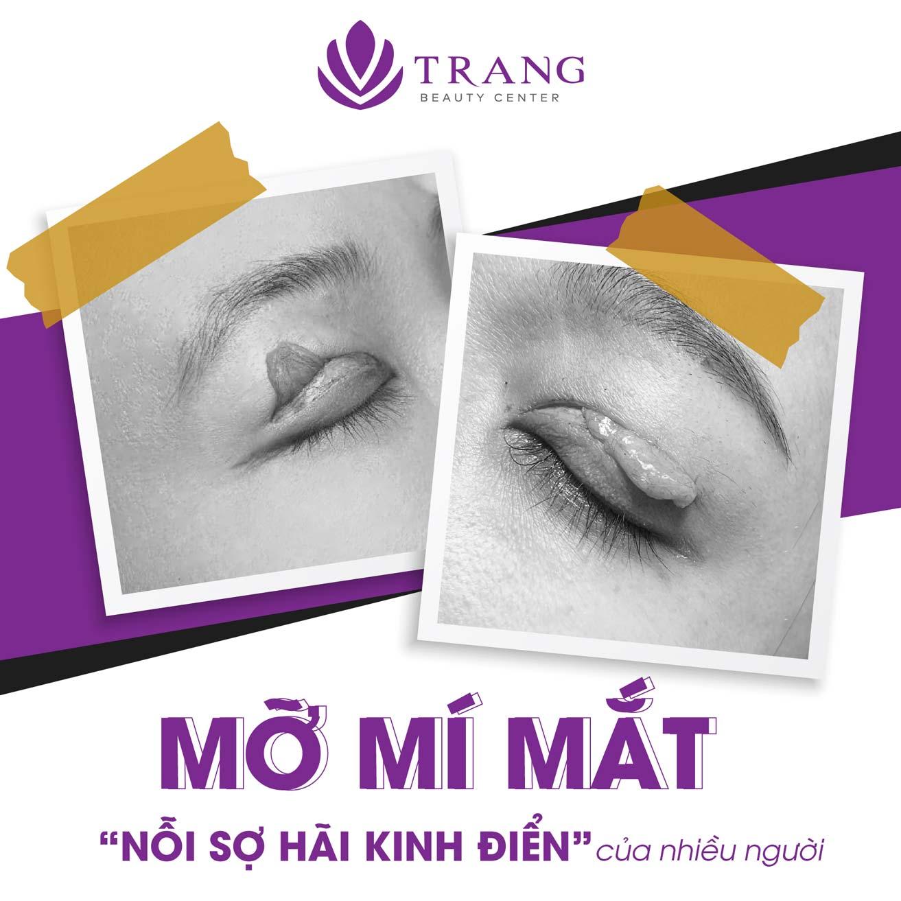 mỡ mí mắt trên