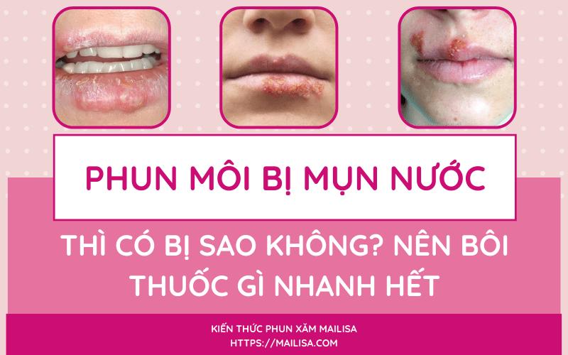 chữa mụn nước ở môi nên bôi thuốc gì