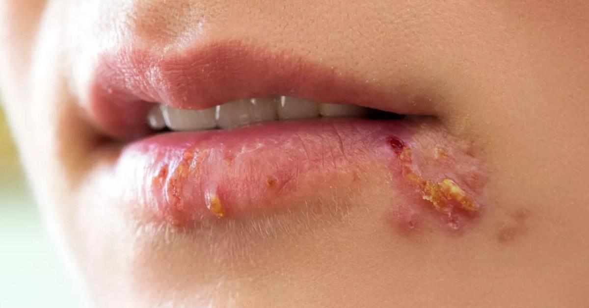 Herpes (Mụn rộp) ở môi