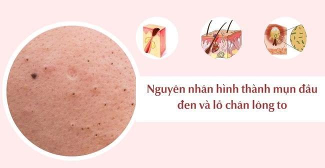 10 Cách trị mụn đầu đen và lỗ chân lông to đơn giản tại nhà