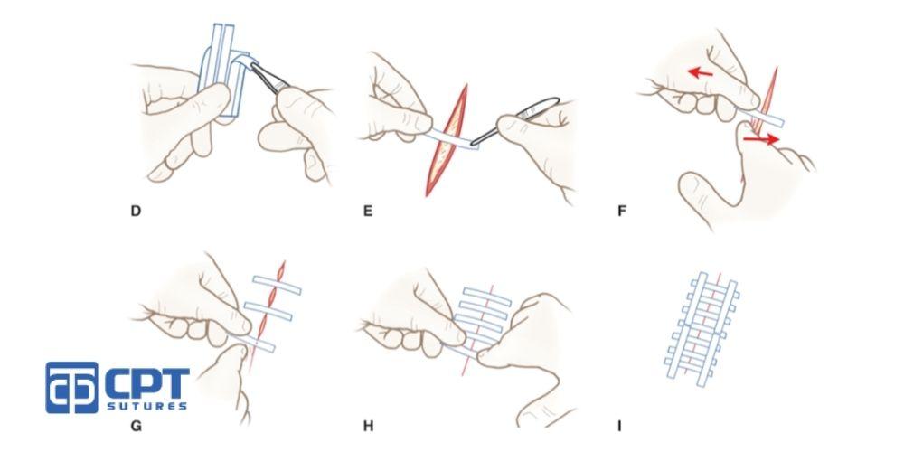 Các mũi khâu vết thương, khâu da cơ bản và nguyên tắc khi khâu vết thương