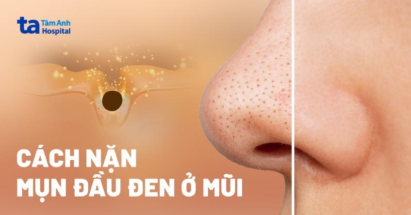 cách nặn mụn đầu đen ở mũi