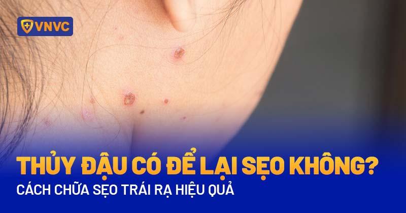 thủy đậu có để lại sẹo không