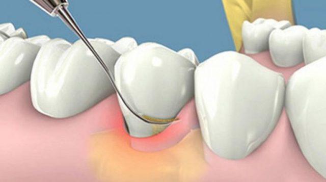 Lấy cao răng tại Đà Nẵng cần lưu ý những vấn đề gì?