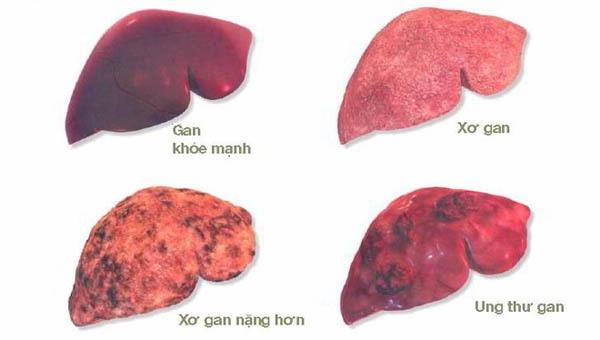 U gan ác tính sống được bao lâu?