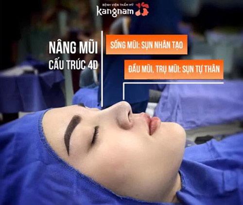 khách hàng nâng mũi kangnam