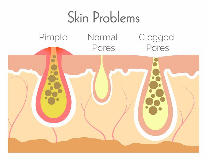 cách trị tắc lỗ chân lông