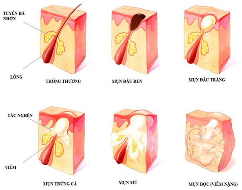 Một số loại mụn nhọt hay gặp