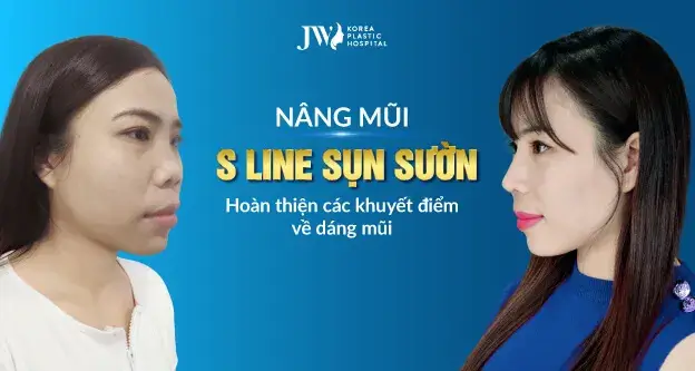 Nâng mũi s line sụn sườn