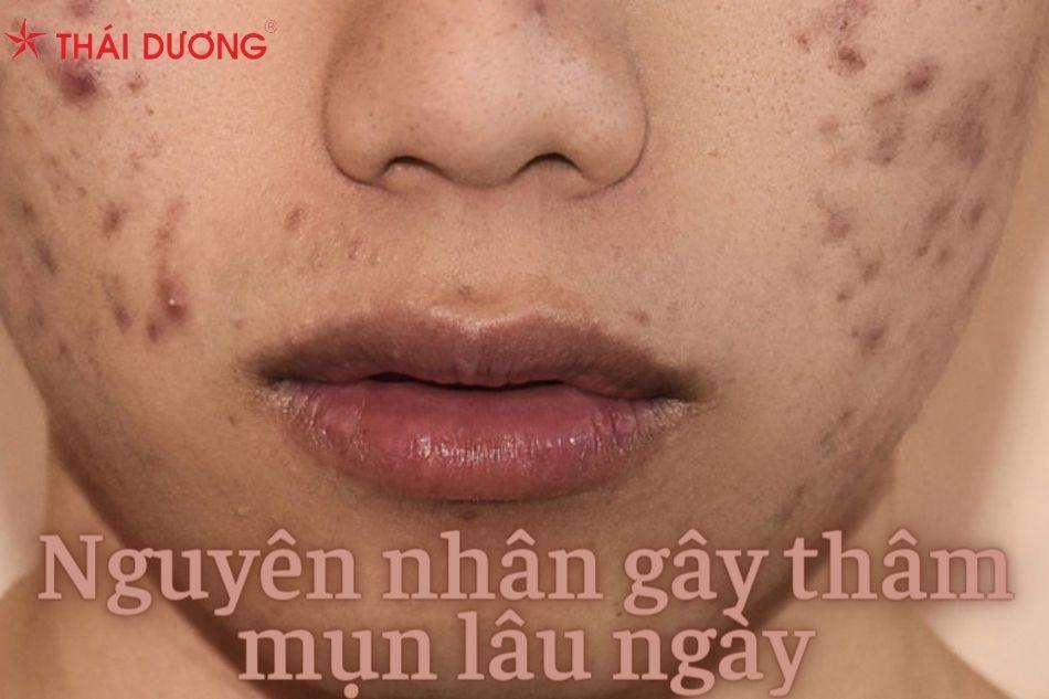 Những nguyên nhân thường gặp dẫn đến tình trạng thâm do mụn lâu ngày