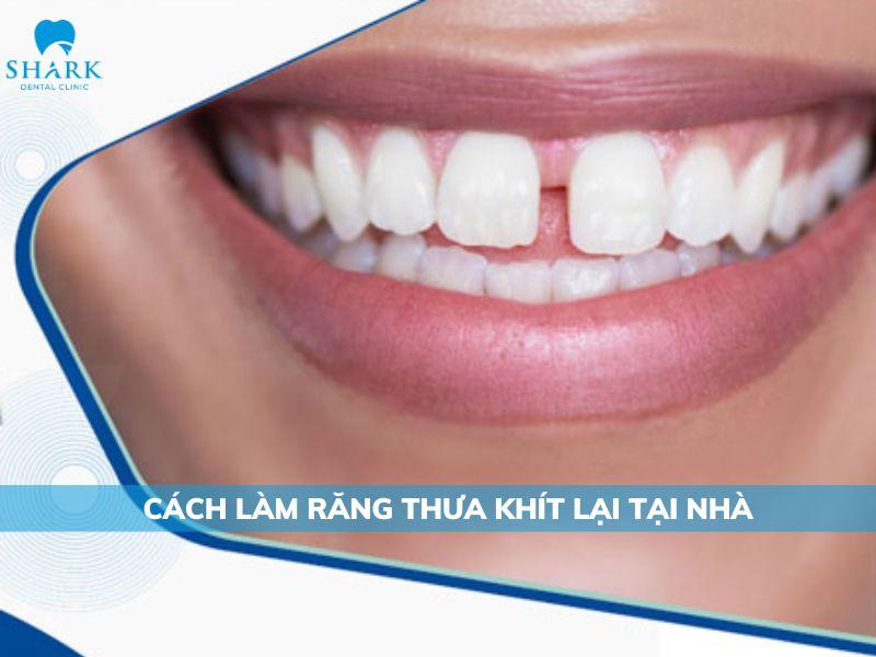 Răng có kích thước nhỏ là nguyên nhân chủ yếu khiến răng thưa