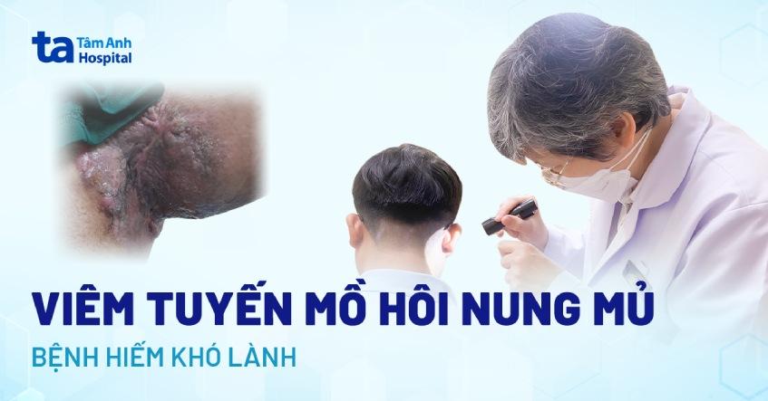 viêm tuyến mồ hôi nung mủ