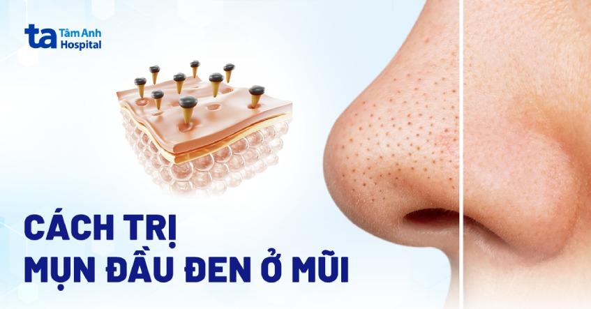 cách trị mụn đầu đen ở mũi