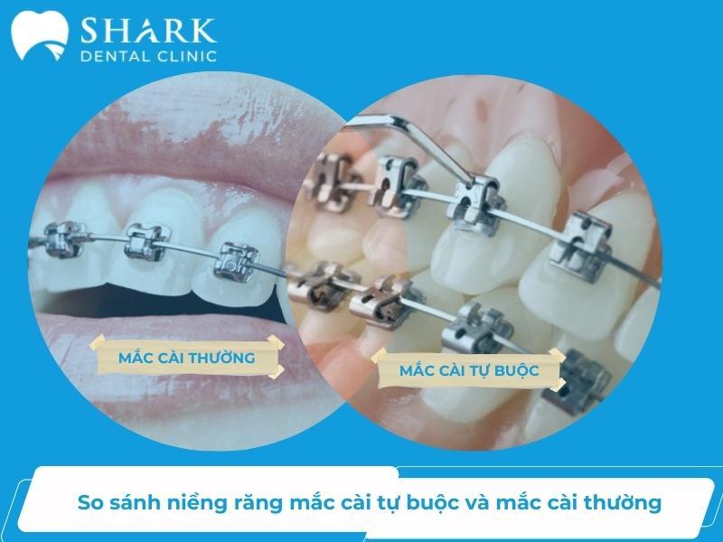 Niềng răng mắc cài thường là phương pháp chỉnh nha dùng dây thun để dịch chuyển răng về đúng vị trí