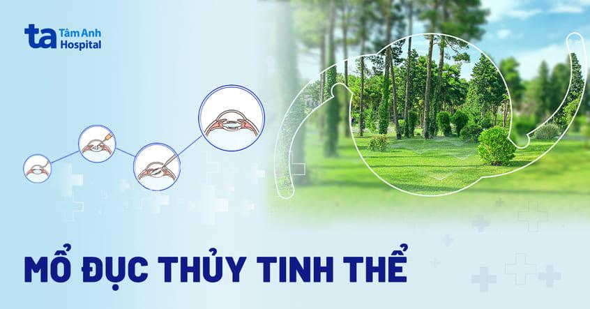 Mổ đục thủy tinh thể: Chỉ định, quy trình và chăm sóc phục hồi