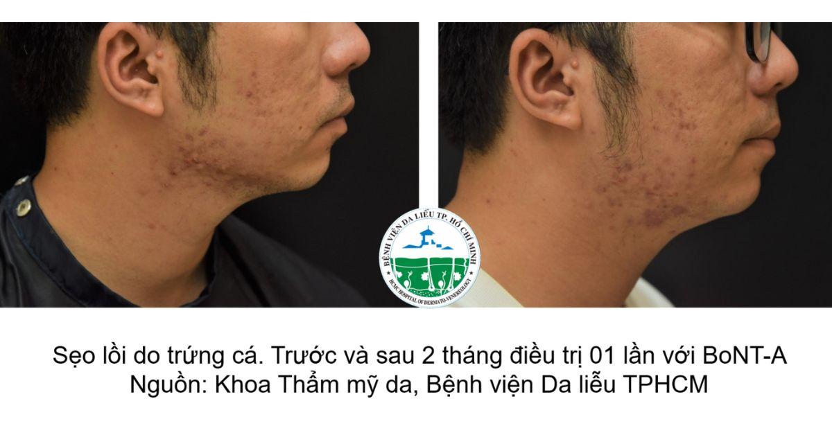 Trị sẹo lồi ở đâu uy tín? Top địa chỉ chuyên khoa tại TP.HCM