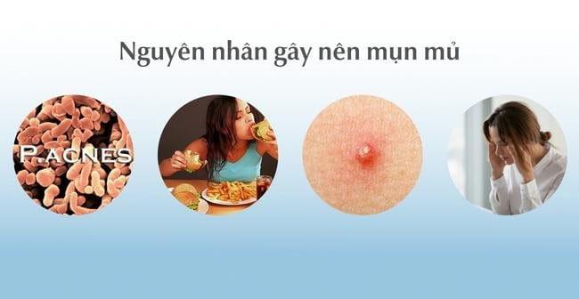 Nguyên nhân gây nên mụn mủ