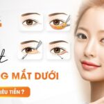 Cắt bọng mắt dưới bao nhiêu tiền?