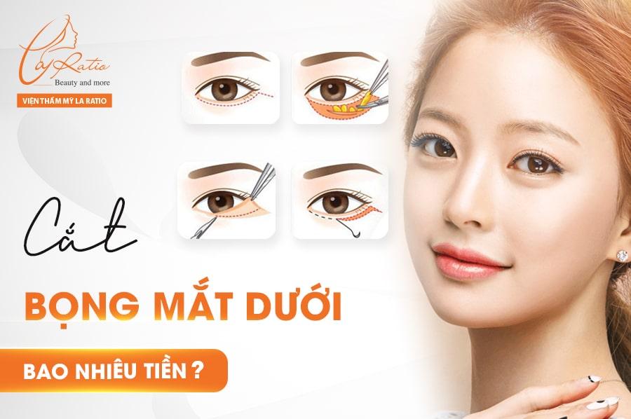 Cắt bọng mắt dưới bao nhiêu tiền?